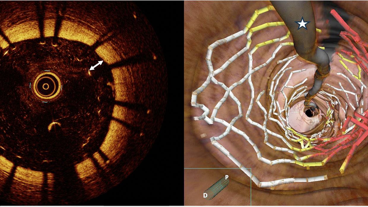 Neue Technologien In Der Interventionellen Behandlung Kardiologie